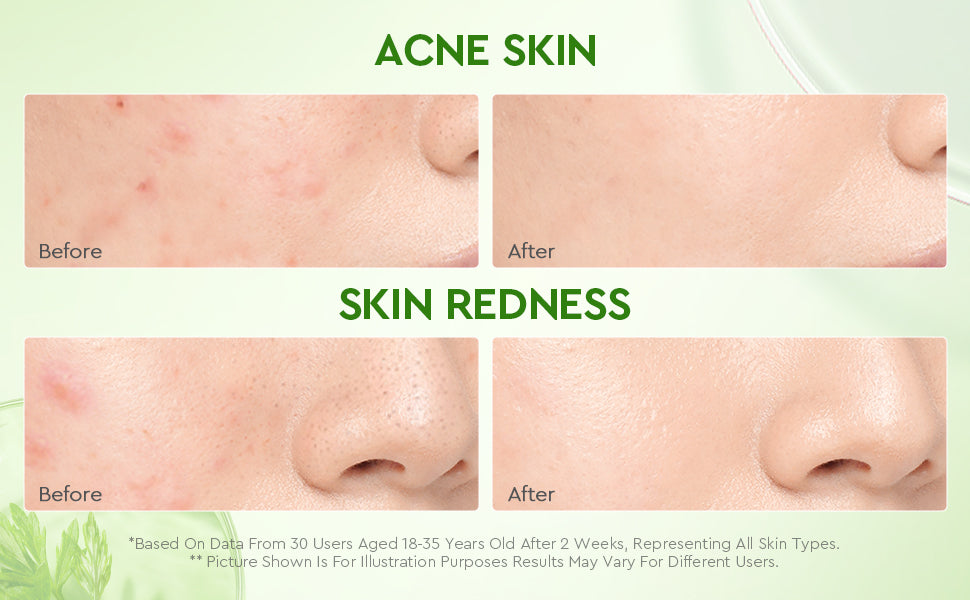 Mugwort Salicylic Acid Acne Clay Stick