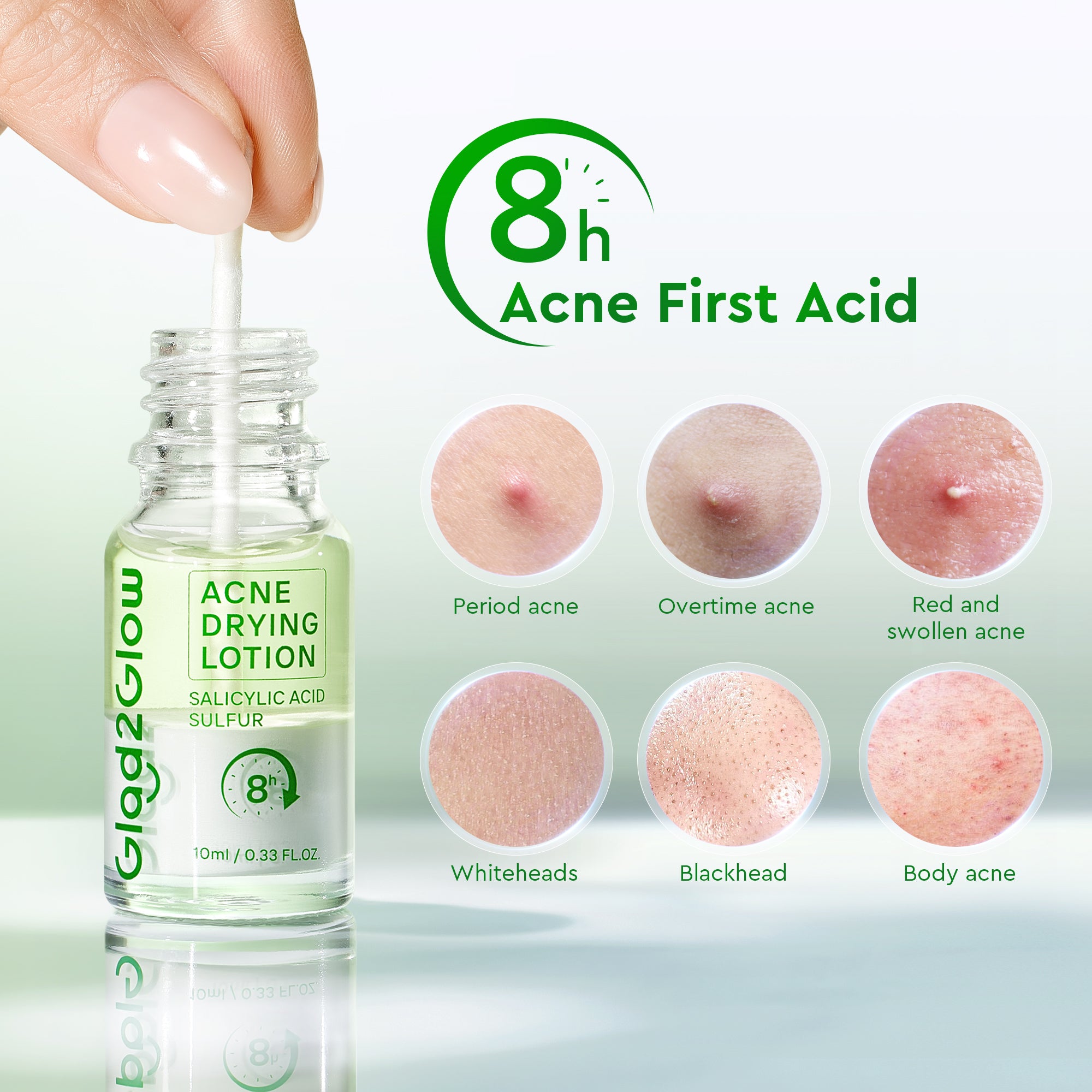 Acne Drying Lotion