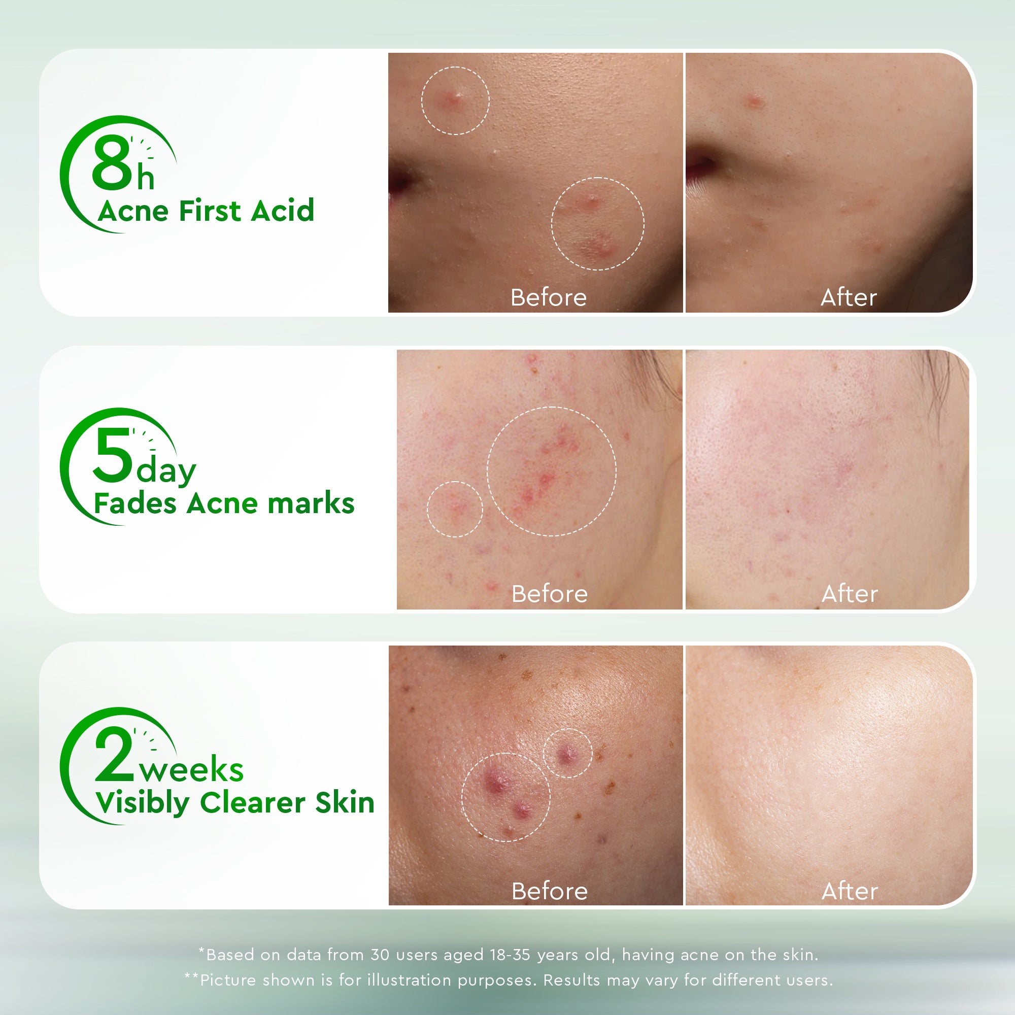 Acne Drying Lotion